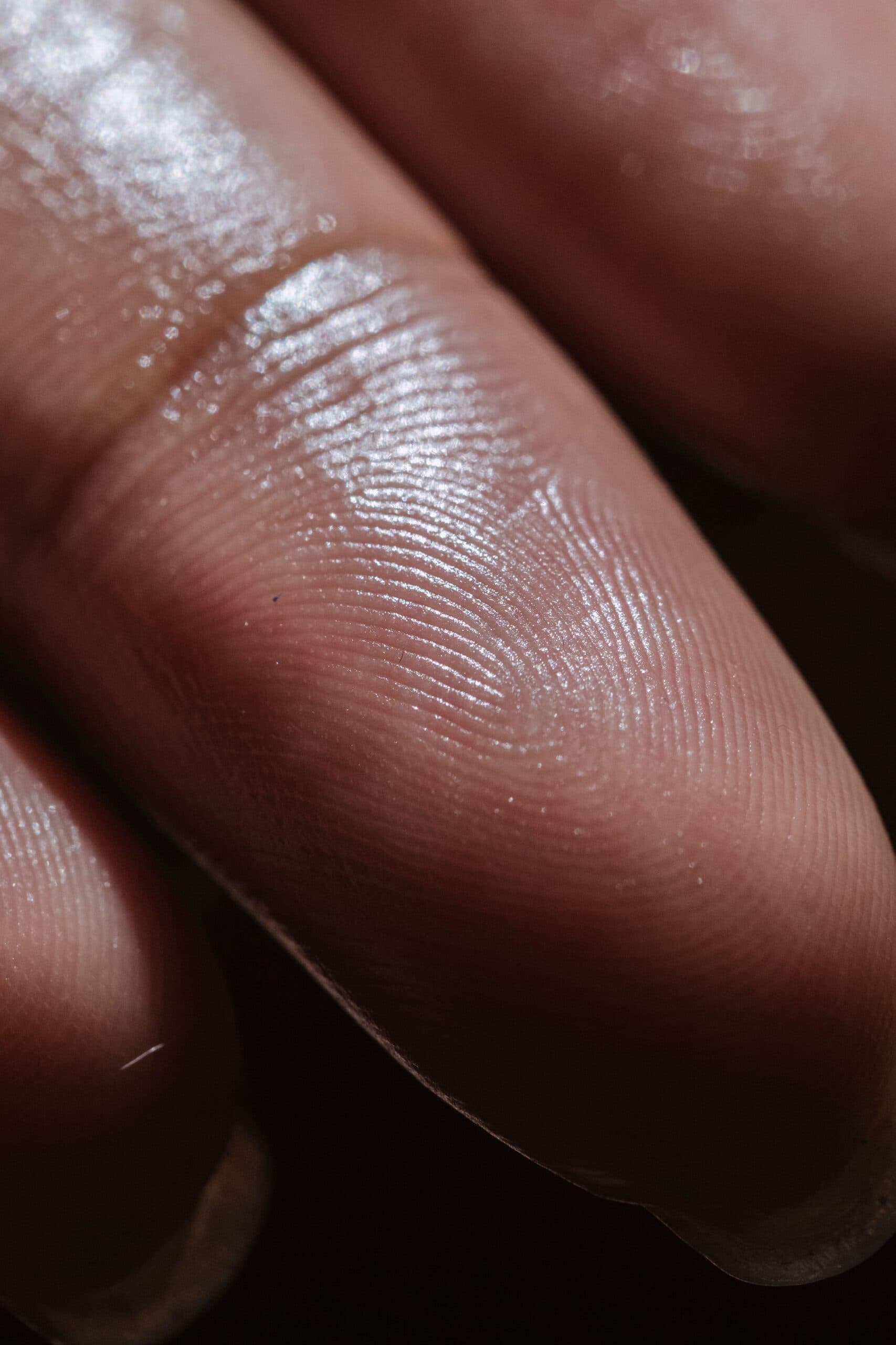 What Is Hyperhidrosis